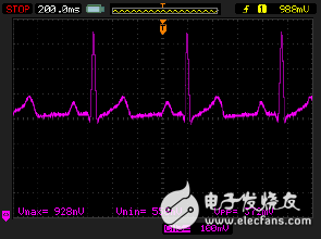 监护仪模拟输出端显示出从电力线耦合而来的噪声