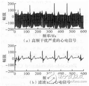 心电信号检测中滤除肌电干扰的方法解析